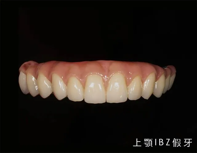 IBZ 彈性複合材假牙