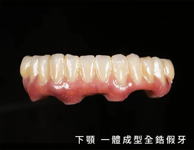 一體成型全鋯瓷假牙