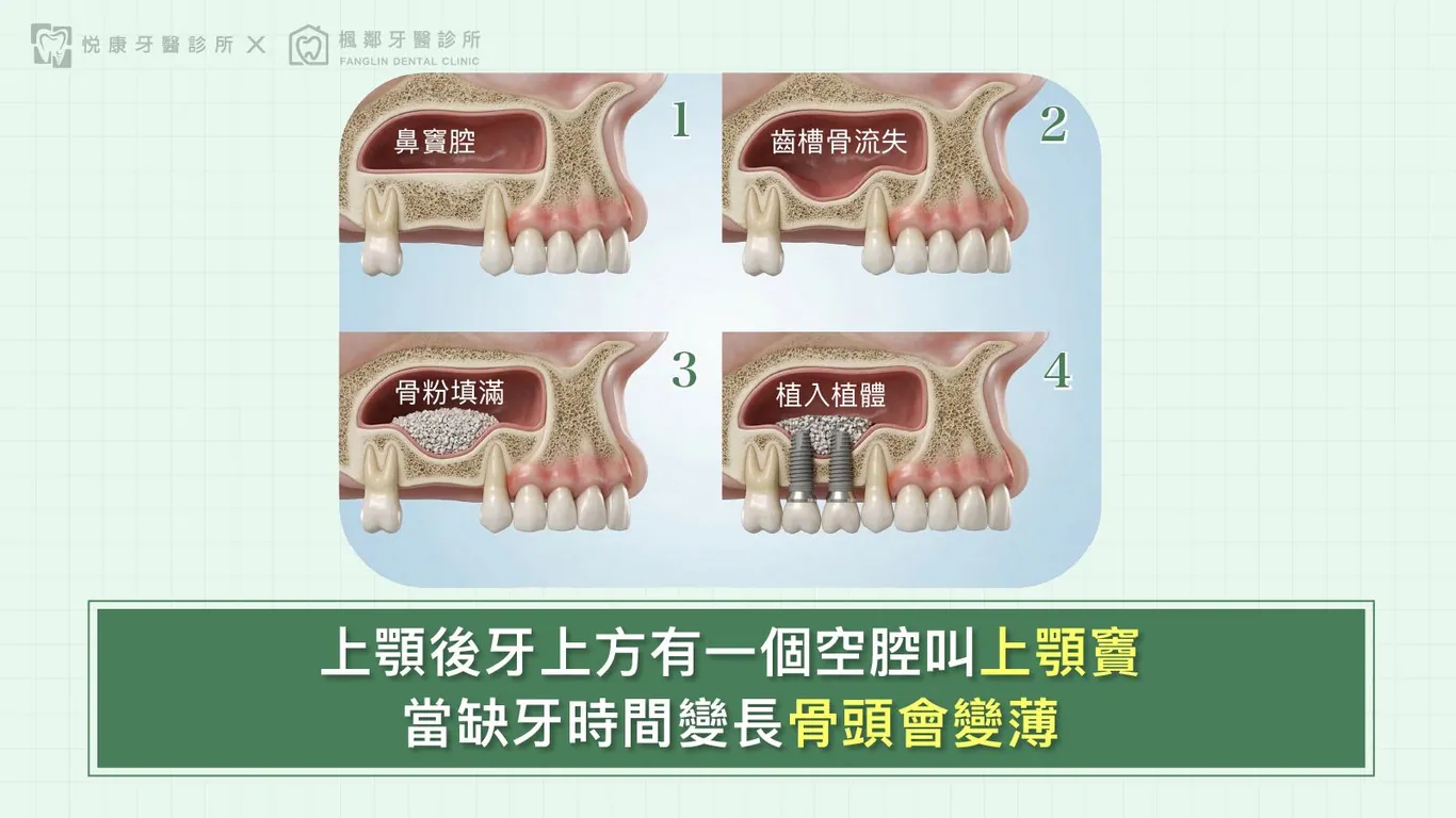 台南全口重建推薦盧佳豪醫師