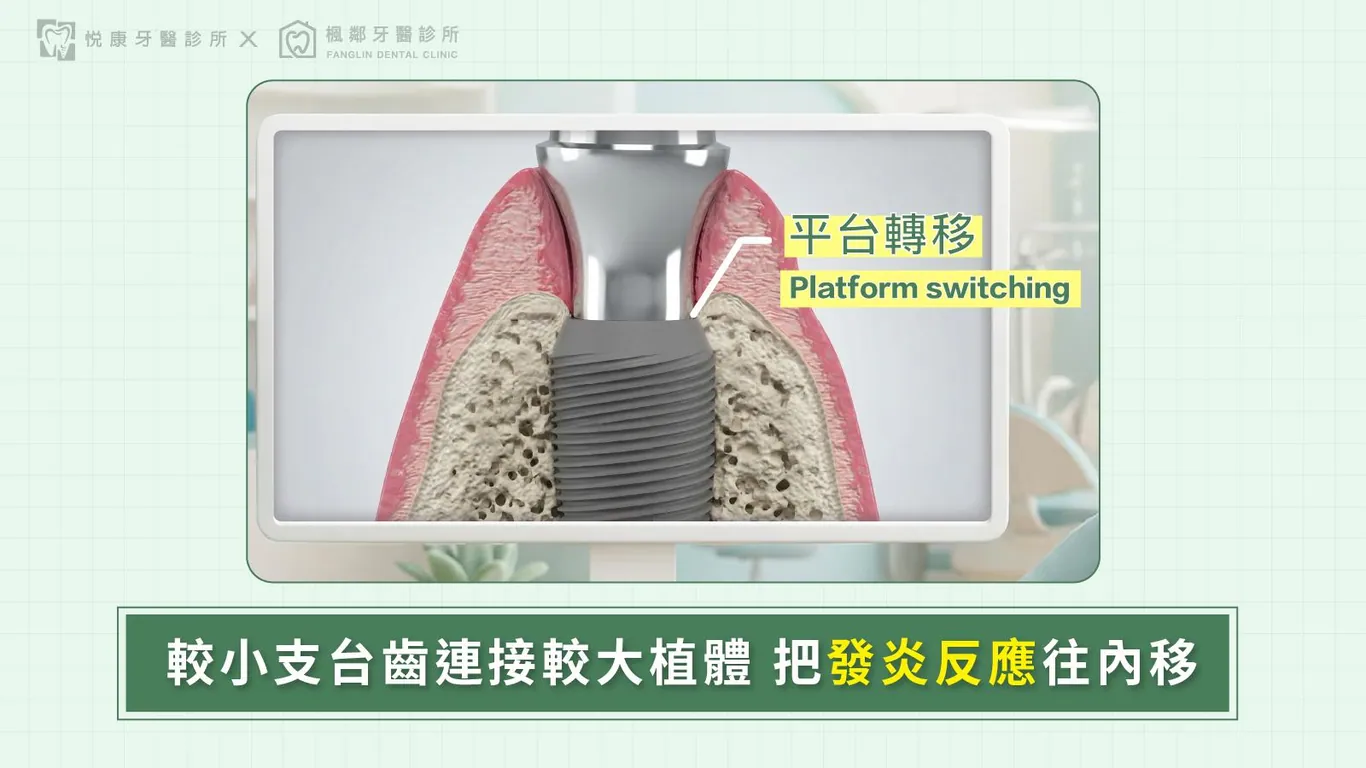 台南全口重建推薦盧佳豪醫師