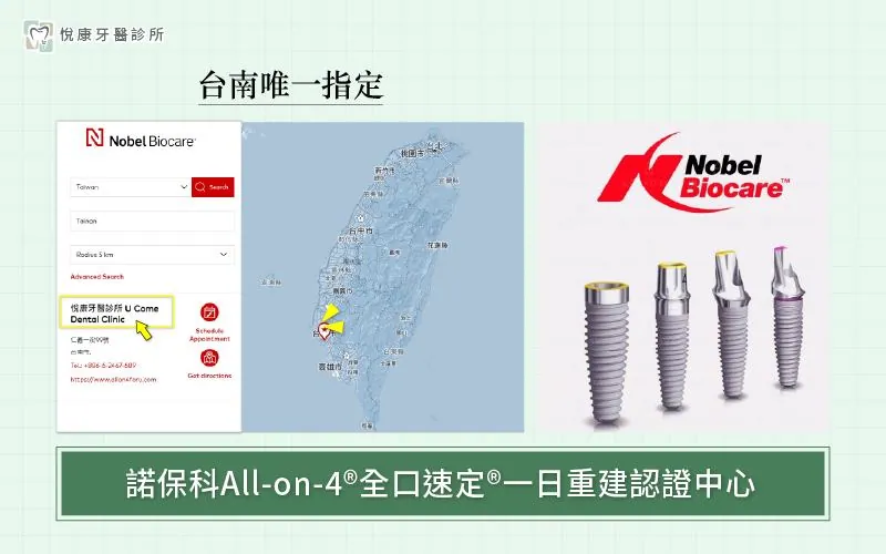 ▍1. 使用什麼植體？