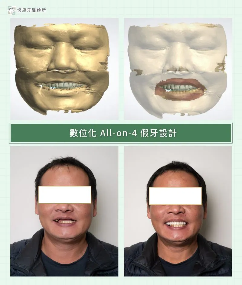 ▍4. 有沒有即時臨時假牙與美學設計？