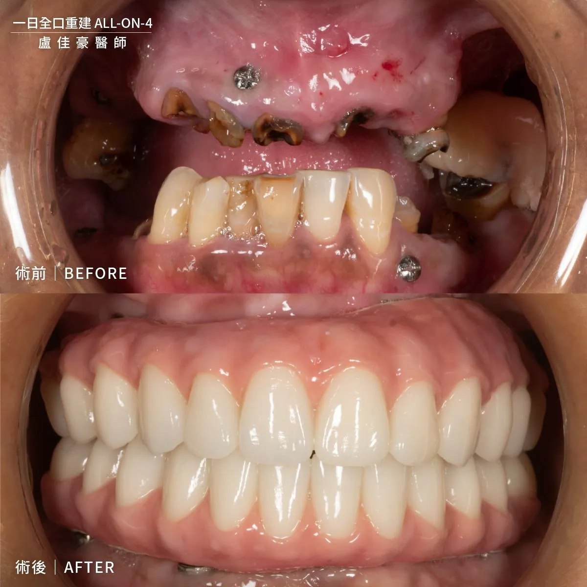 案例 35